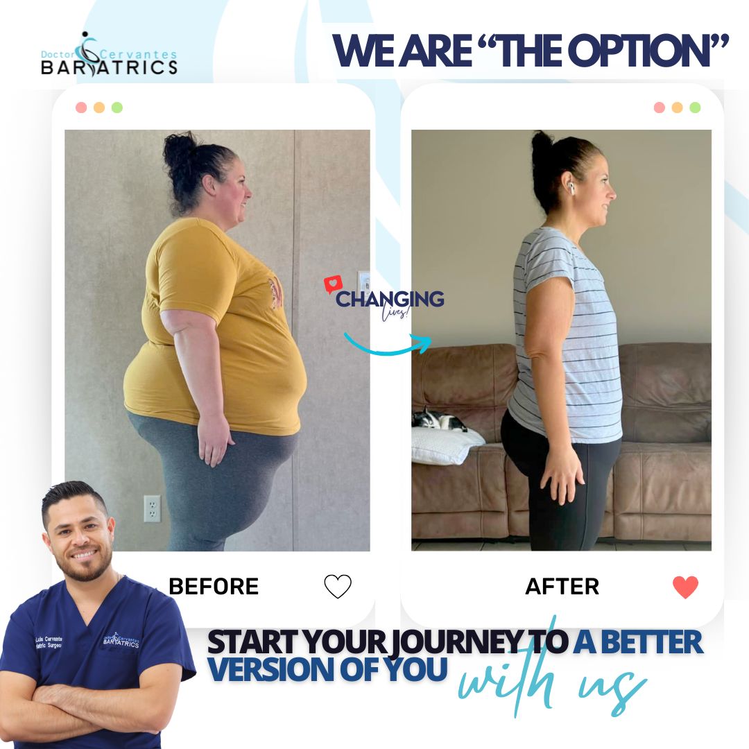 Before and after gastric sleeve patient — Cervantes Bariatrics Tijuana