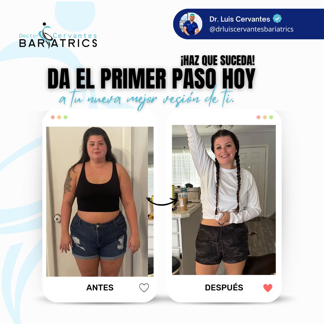 Before and after weight loss surgery in Mexico with Dr. Cervantes