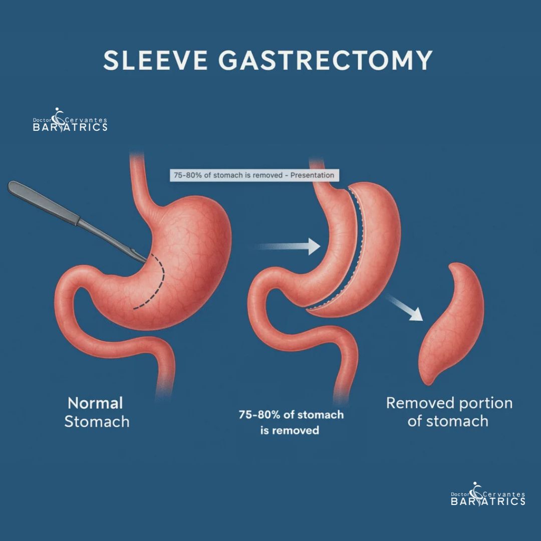 Medical illustration showing how the gastric sleeve procedure reduces stomach size into a banana shape
