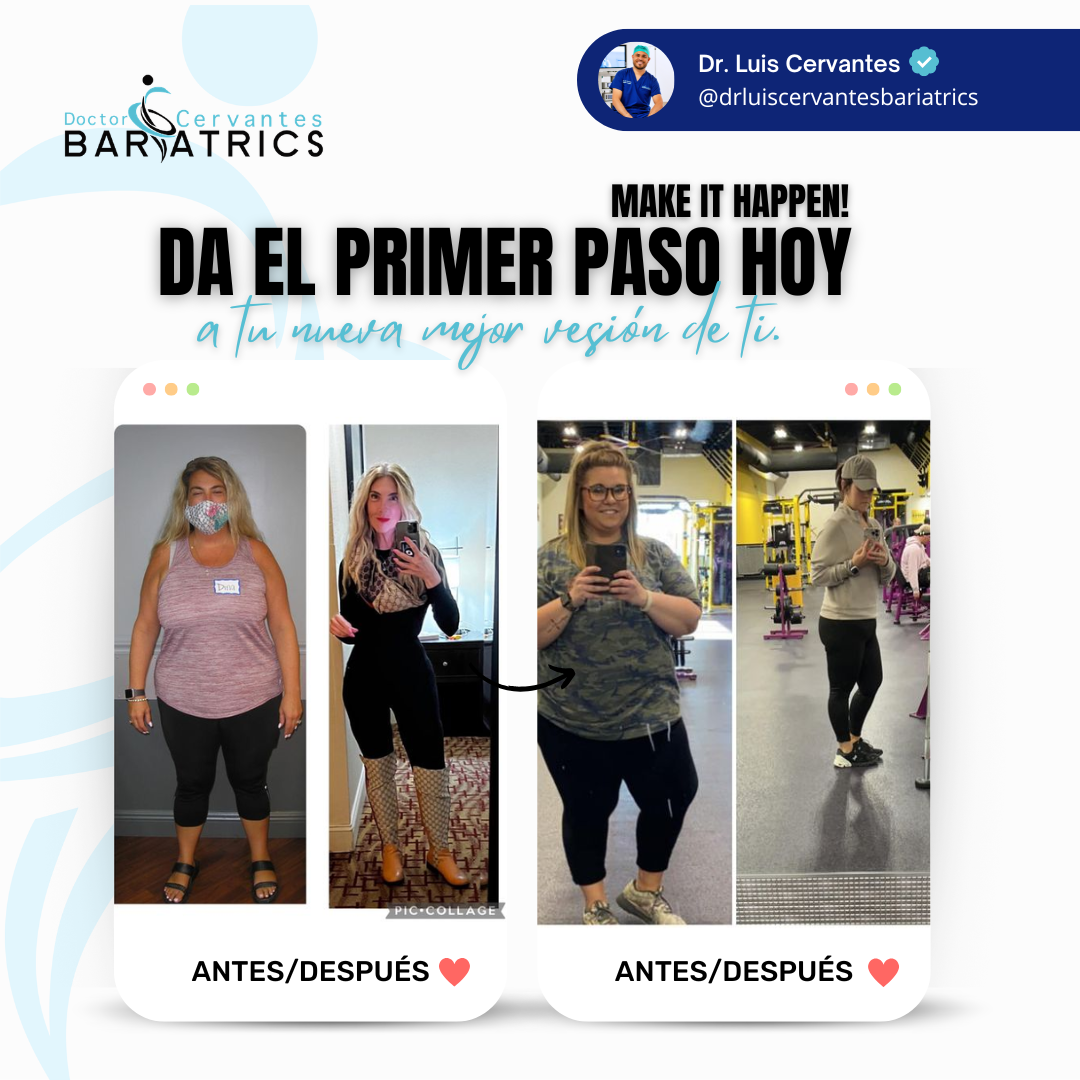 Before and after bariatric surgery with Dr. Cervantes