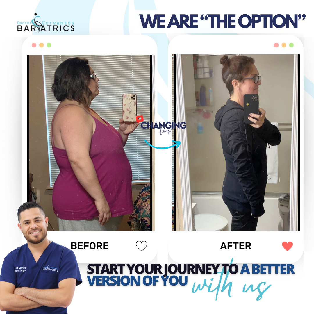 Before and after weight loss patient in Tijuana