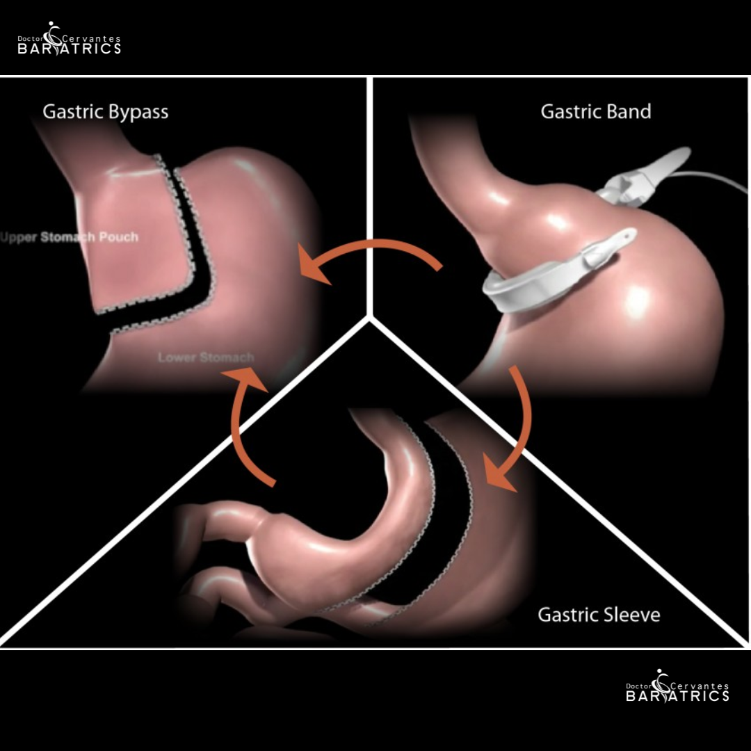 Medical illustration explaining bariatric revision and conversion surgery in Tijuana