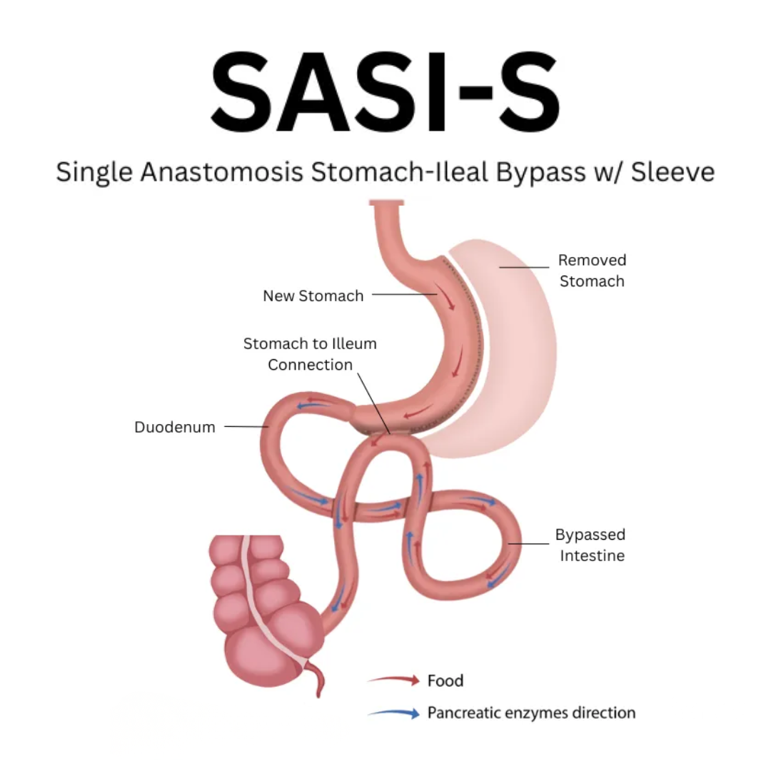 Medical illustration explaining the SASI-S surgical procedure in Tijuana