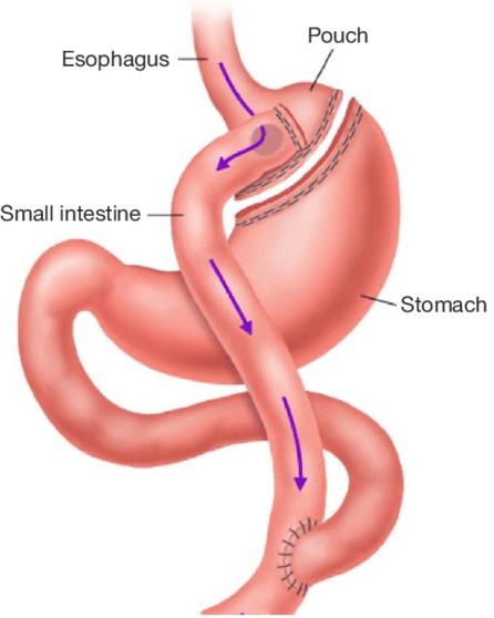 Medical illustration explaining the gastric bypass surgical procedure