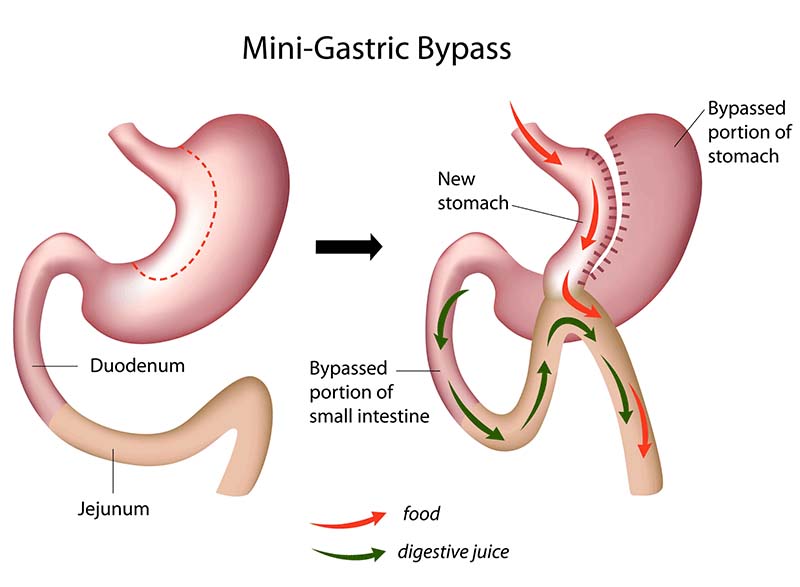 Medical illustration explaining the mini gastric bypass surgical procedure