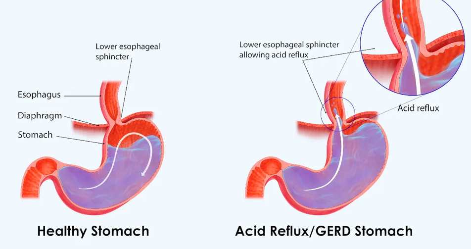 Severe GERD after Gastric Sleeve