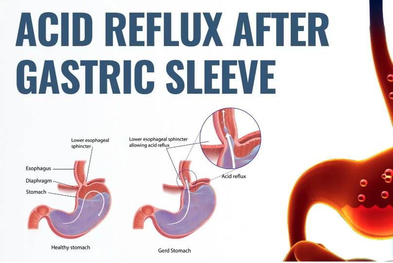 Anatomical explanation of Acid Reflux after Bariatric Surgery