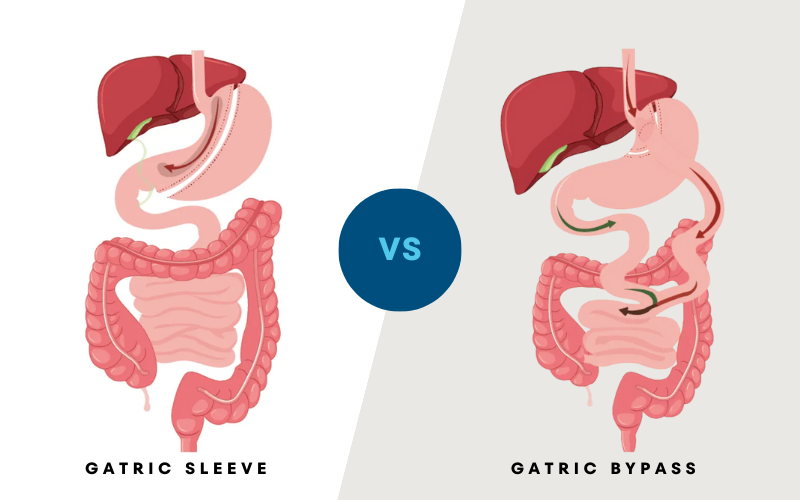 Anatomical comparison of Gastric Sleeve versus Gastric Bypass