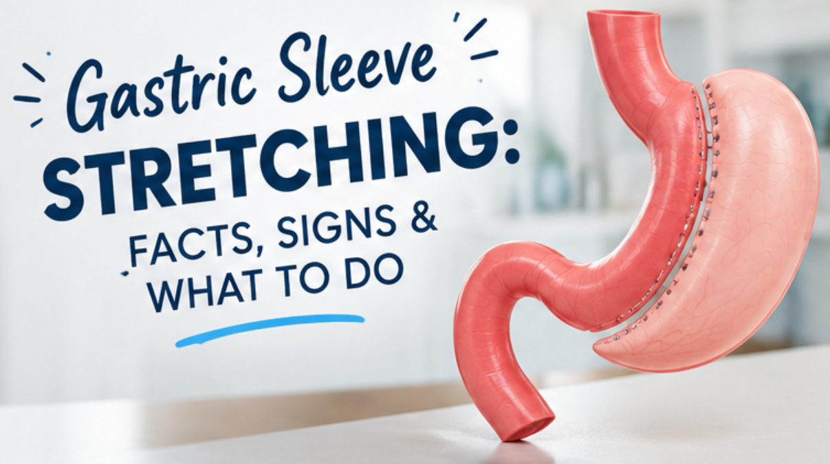 Illustration explaining how to know if your gastric sleeve has stretched