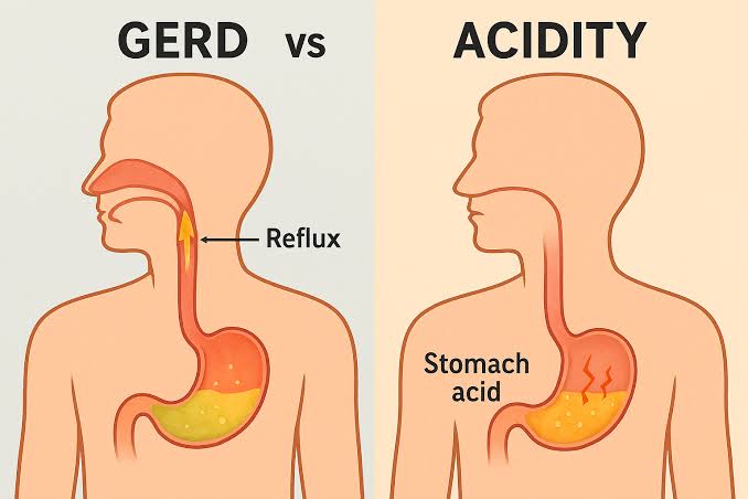 Illustration explaining the difference between normal acidity and GERD